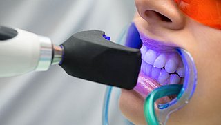 Tanden laten bleken: wat wordt er vergoed door je tandartsverzekering?