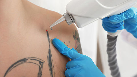 Tattoo verwijderen: hoelang duurt het en wat zijn de kosten?