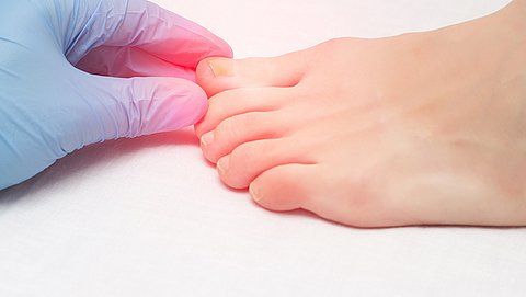Kalknagels: vies, ongewild en enorm lastig om vanaf te komen. Dit zijn de best werkende remedies