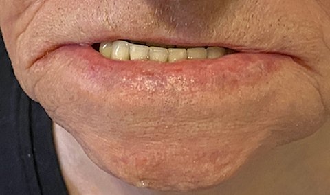 Gescheurde mondhoeken: wat kan ik doen?