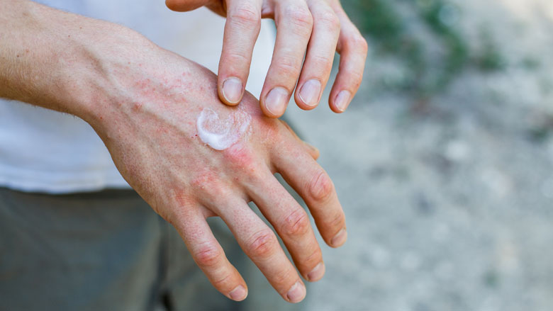 Last van handeczeem door het handen wassen? Dit kun je doen