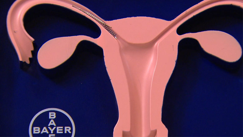 Gynaecologen zeggen toe Essure-implantaten te verwijderen