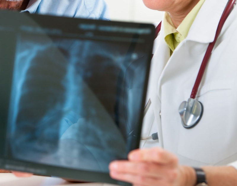 'Longkankermiddel nivolumab niet in basispakket'