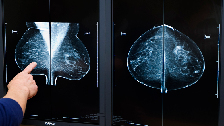 'Preventieve borstamputatie blijkt niet nodig voor BRCA2-dragers'