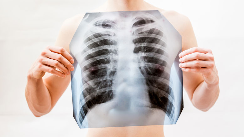 Aantal tuberculosepatiënten gestegen
