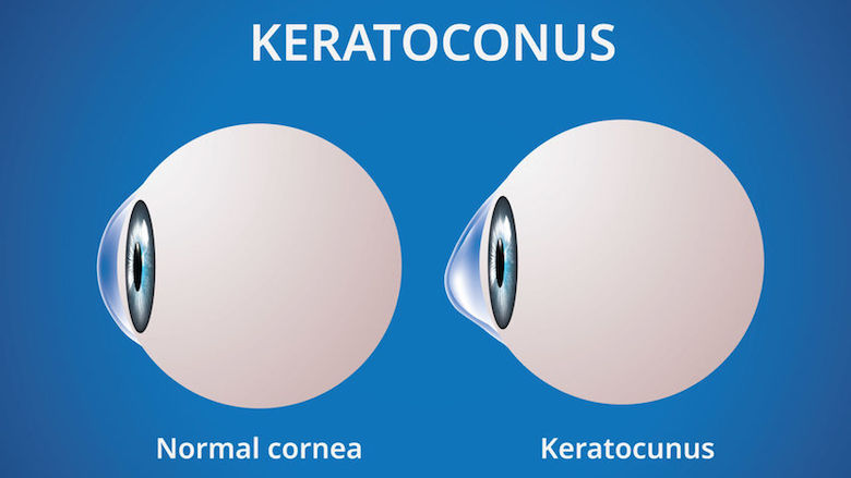 De oogziekte keratoconus komt vaker voor dan gedacht, wat moet je weten?